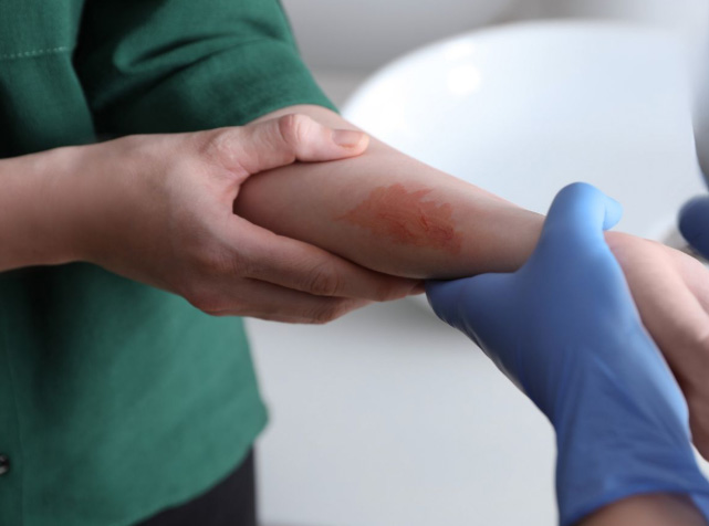 Not all burns are alike, and their treatments shouldn’t be either